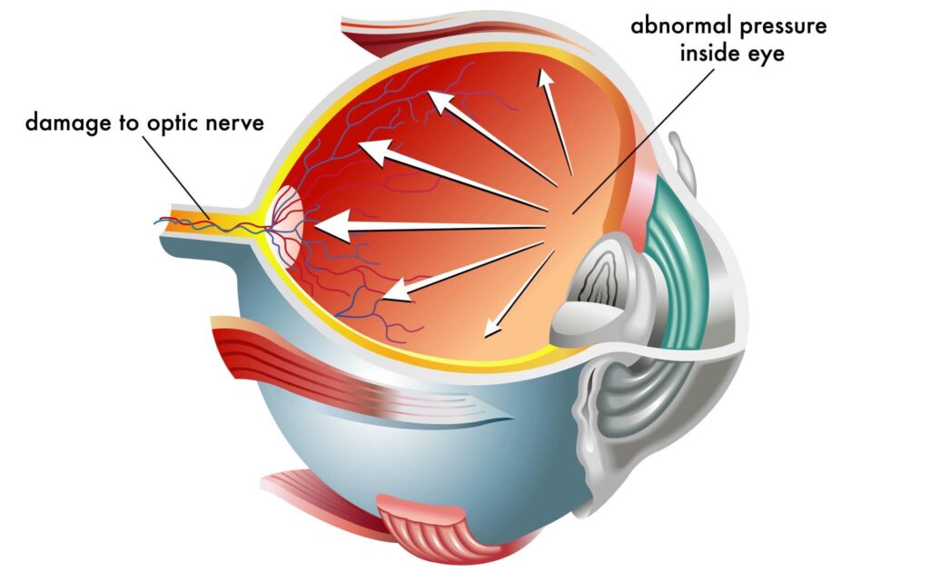 Nuevas técnicas quirúrgicas para el tratamiento del glaucoma