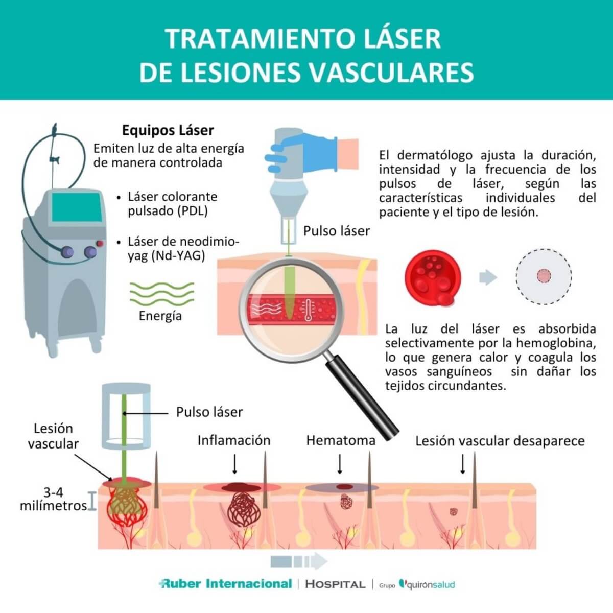 Tratamiento láser de las lesiones vasculares cutáneas - Con I de ...