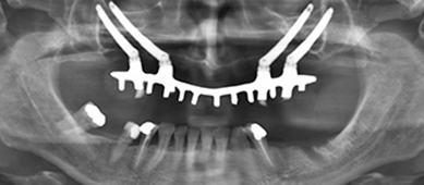 Soluciones innovadoras ante implantes dentales con limitación ósea
