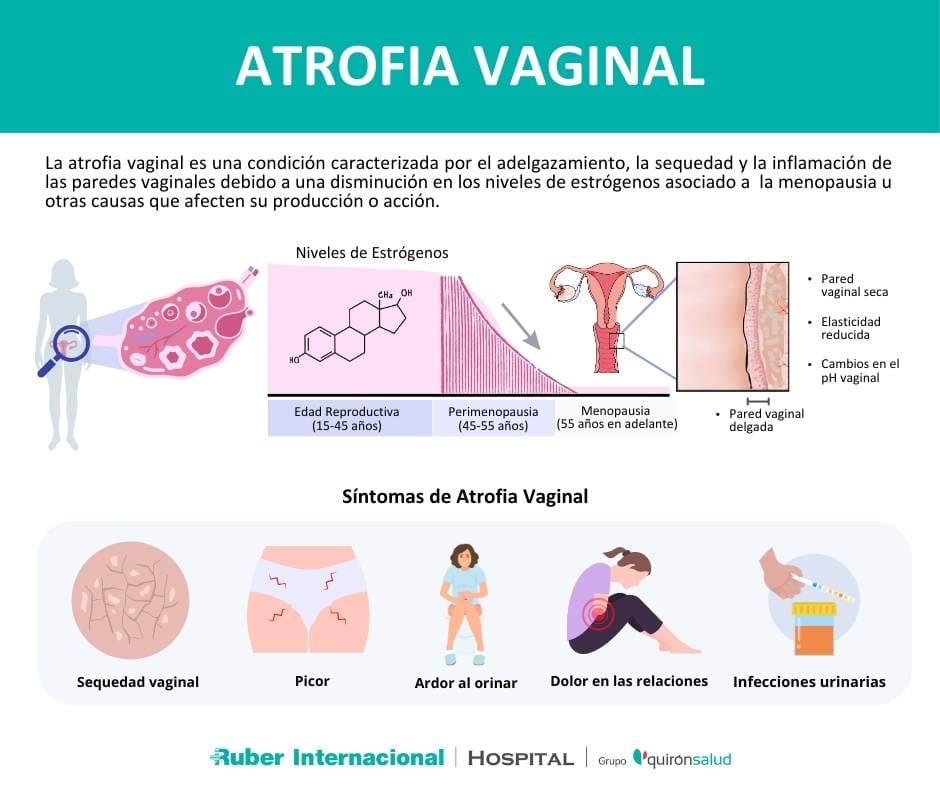 Así es el tratamiento de la atrofia vaginal con láser de CO2 fraccionado