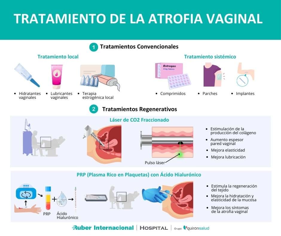 Así es el tratamiento de la atrofia vaginal con láser de CO2 fraccionado