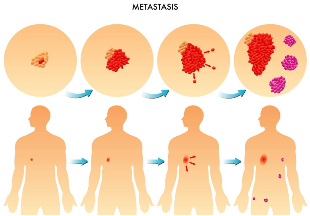 Así es la lucha entre células cancerígenas para contener o desarrollar el tumor