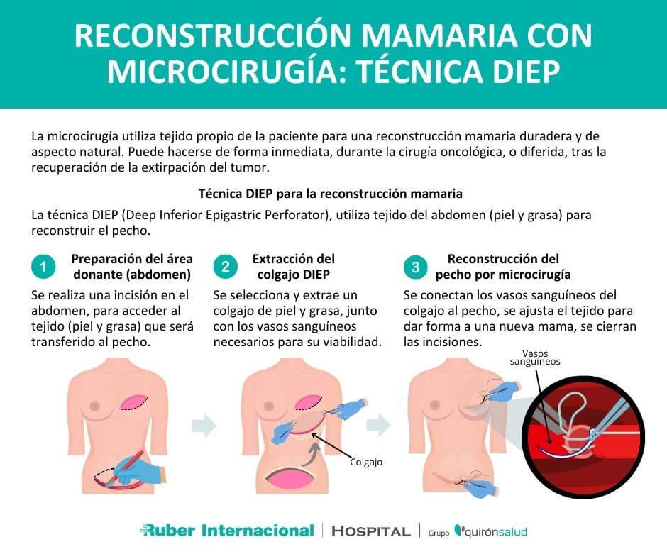 Así es la reconstrucción mamaria con microcirugía en pacientes con cáncer de mama