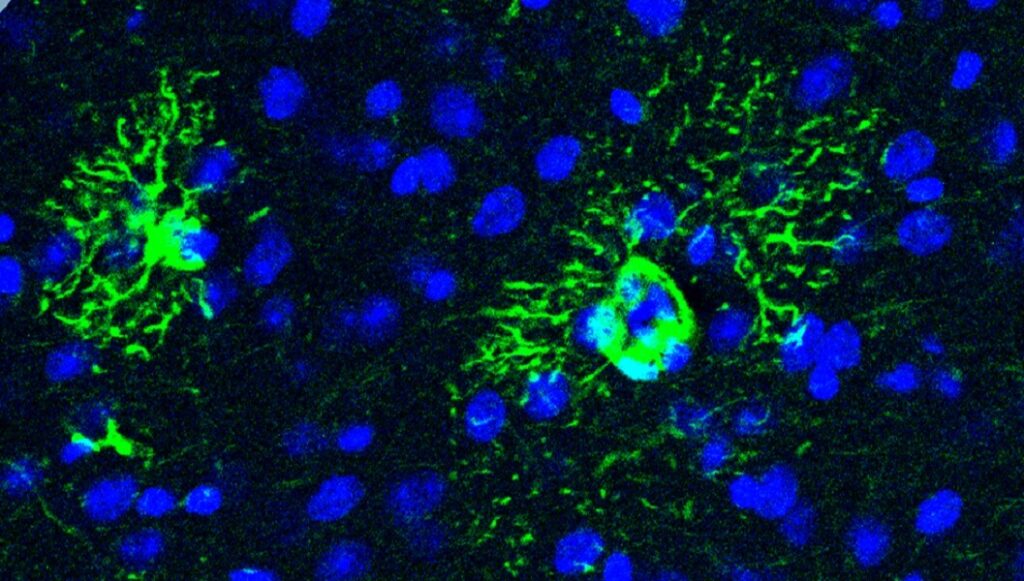 Una proteína provoca cambios en el cerebro que anticipan el alzhéimer