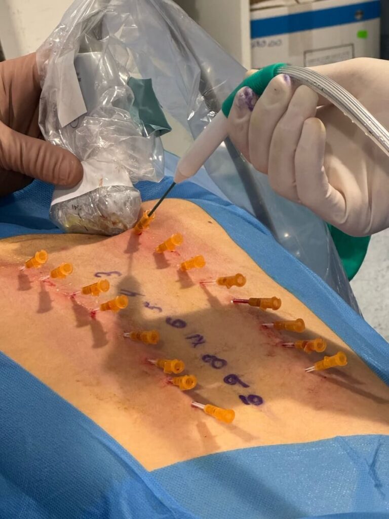Crioanalgesia para bloquear el dolor en cirugía pediátrica