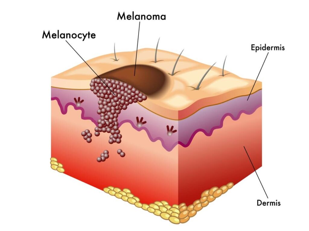 ¡Así lucha el talento científico contra el agresivo melanoma!