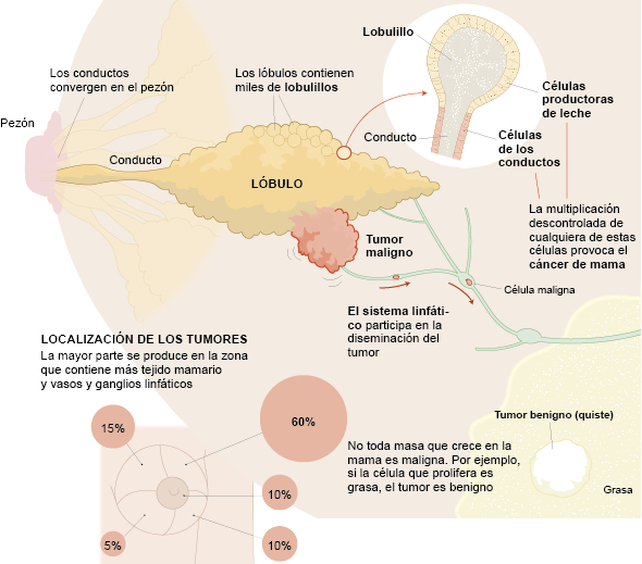 ¡Científicos cerca de vencer al cáncer de mama más agresivo!