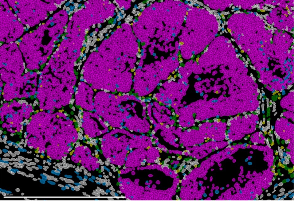 Identificado el gen que regula el potencial metastásico en el cáncer de mama