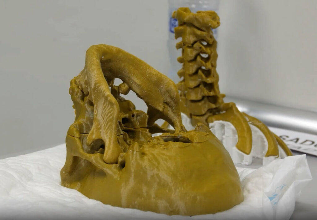 La Unidad de Tecnologías Avanzadas en Diseño e Impresión 3D -UTADI 3D- del Hospital Universitario 12 de Octubre de Madrid refuerza liderazgo en esta tecnología.
